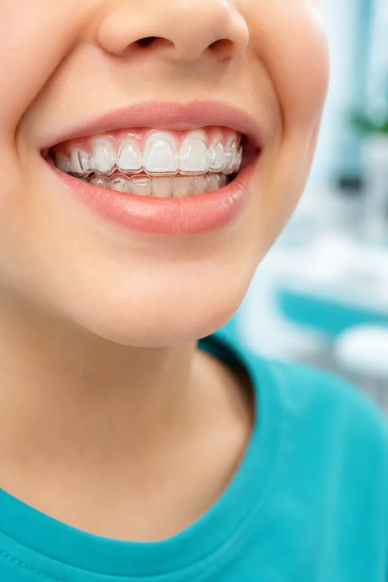Invisalign para niños en Medellín - alineadores invisibles infantiles